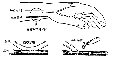 동정맥루